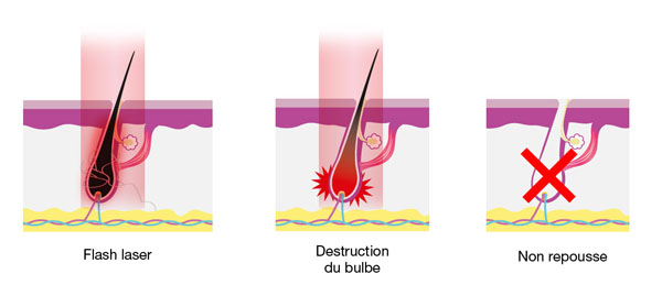 Schéma de fonctionnement de l'épilation laser